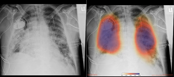 chest x-ray-1